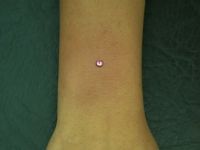 PIERCING MICRODERMAL EN MUECA