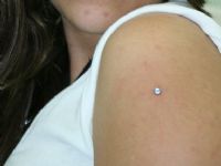 MICRODERMAL EN EL BRAZO