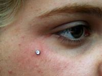 PIERCING MICRODERMAL